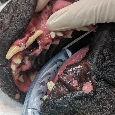 Avulsion of Teeth