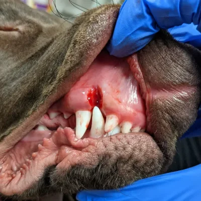 Gingivoplasty