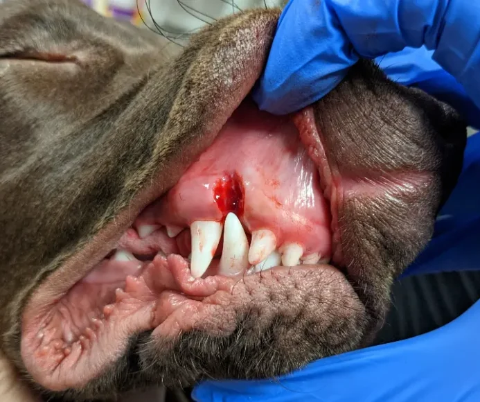 Gingivoplasty
