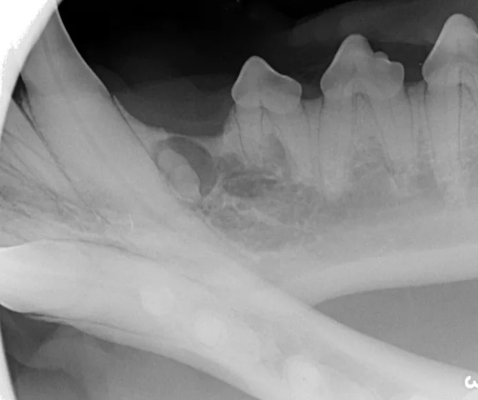 Dentigerous Cysts