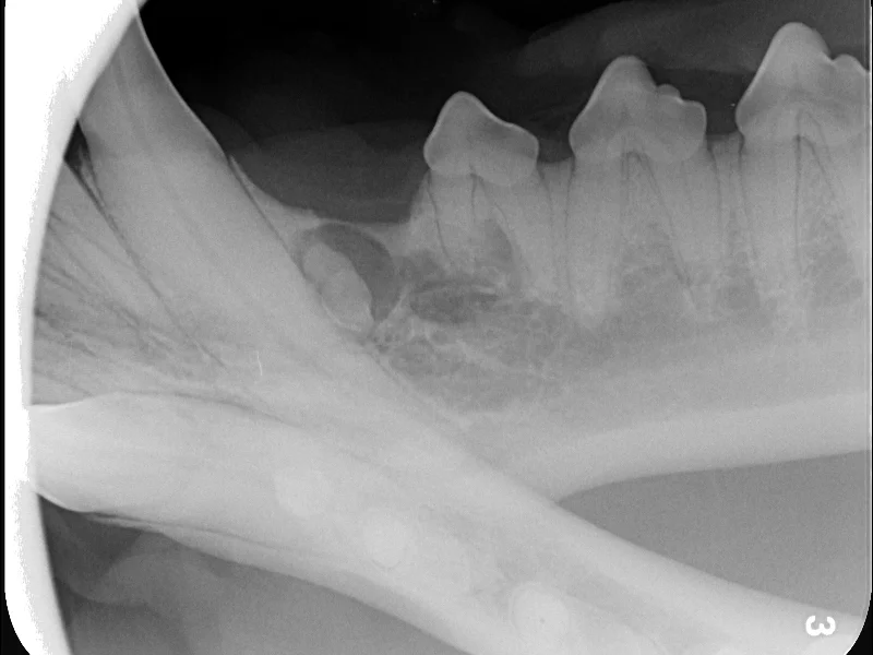 Dentigerous Cysts
