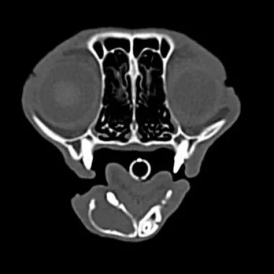 Mandibulectomies and Maxillectomies