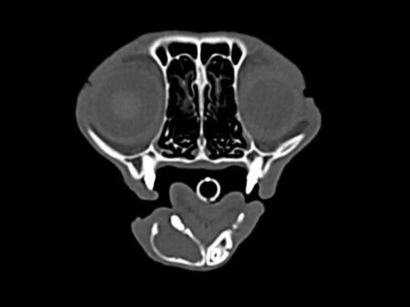Mandibulectomies and Maxillectomies
