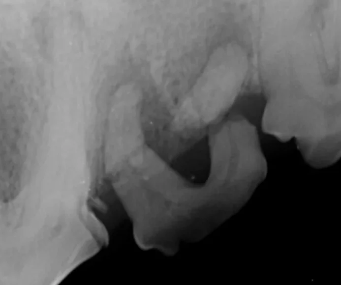 Pulp Exposed Teeth