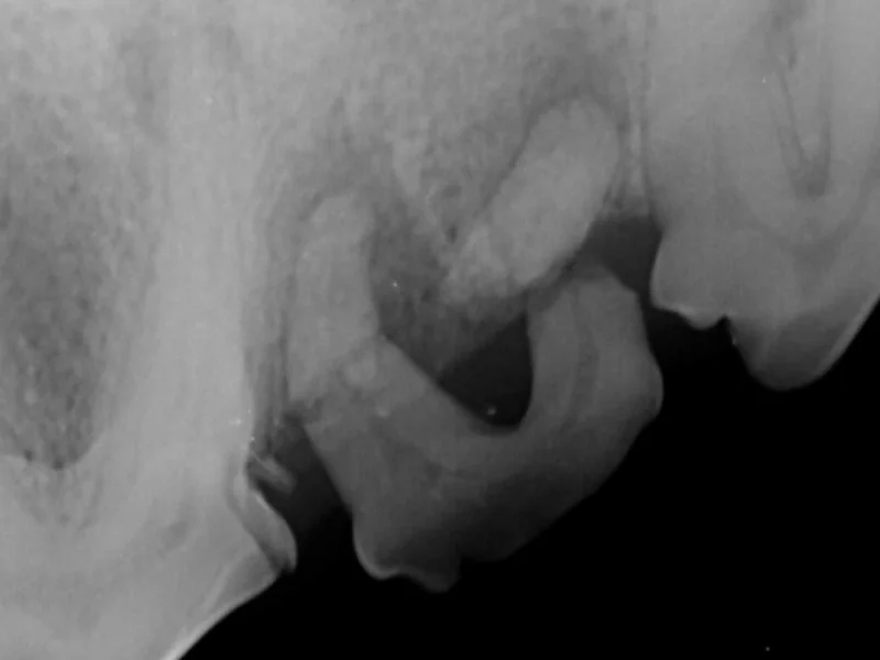 Pulp Exposed Teeth