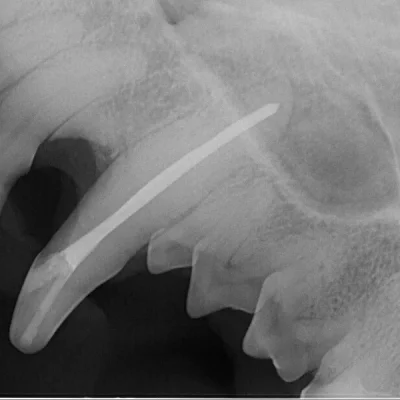 Root Canal Therapy