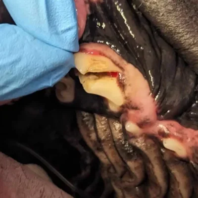 Fractured/Broken Teeth