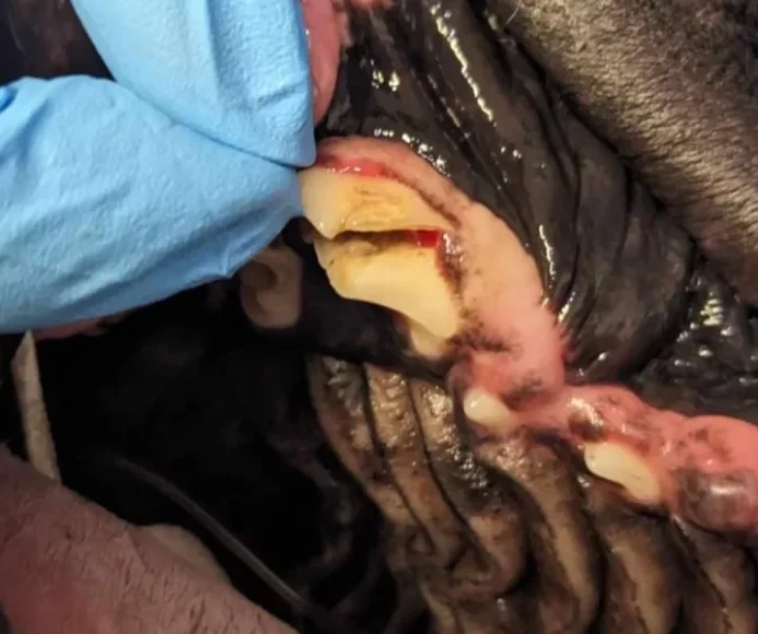 Fractured/Broken Teeth