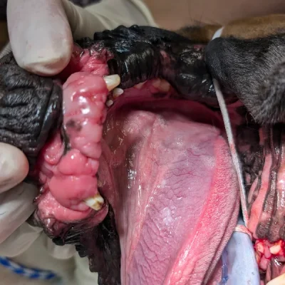 Gingival Enlargement