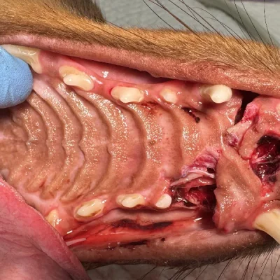 Jaw Fractures