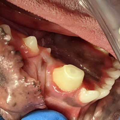 Vital Pulpotomy